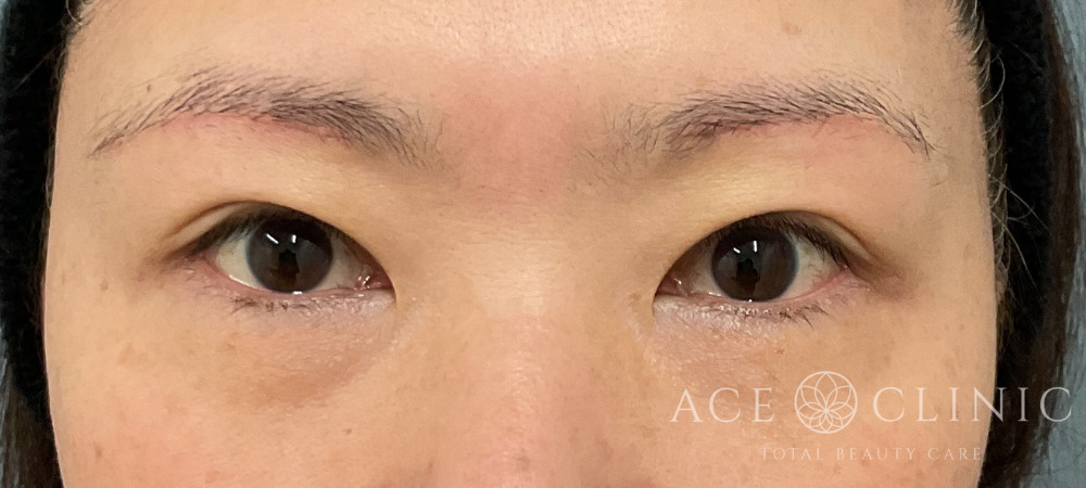 眉毛下切開｜埋没｜症例18｜50代女性｜術後3ヶ月｜エースクリニック大阪梅田HEPナビオ院