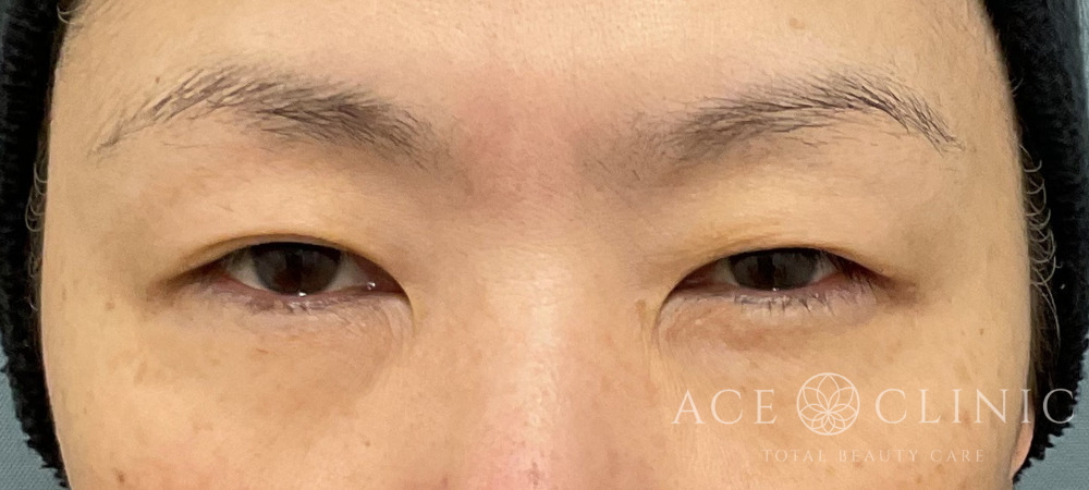 眉毛下切開｜埋没｜症例18｜50代女性｜術前｜エースクリニック大阪梅田HEPナビオ院