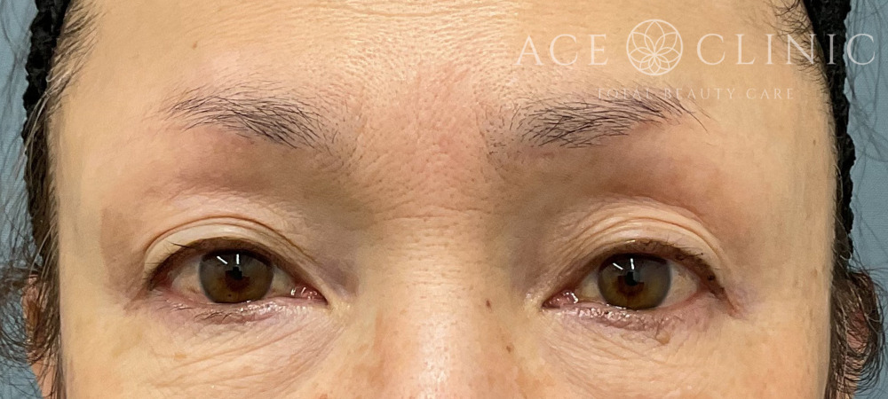 眉毛下切開｜症例53｜60代女性｜術後6ヶ月｜エースクリニック大阪梅田HEPナビオ院