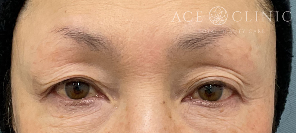 眉毛下切開｜症例53｜60代女性｜術前｜エースクリニック大阪梅田HEPナビオ院