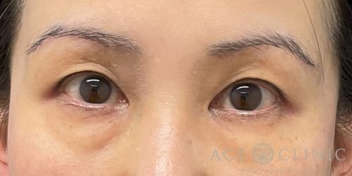 眉毛下切開法|症例54|50代女性|術後1ヶ月|エースクリニック大阪梅田HEPナビオ院