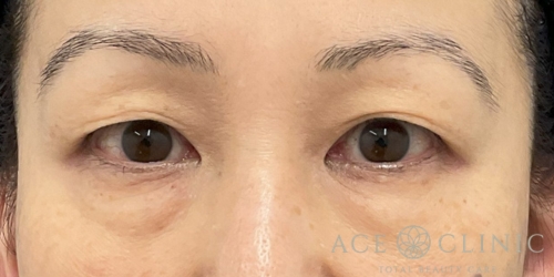 眉毛下切開法|症例54|50代女性|術前|エースクリニック大阪梅田HEPナビオ院