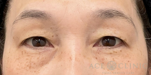 眉毛下切開法｜症例55｜50代女性｜術前｜エースクリニック大阪梅田HEPナビオ院