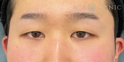 二重埋没法|症例64|20代男性|術前|エースクリニック大阪梅田HEPナビオ院