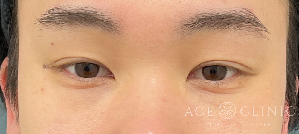 二重まぶた埋没法｜症例62｜20代男性｜術後1ヶ月｜エースクリニック大阪梅田HEPナビオ院