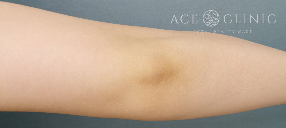 ミラノリピール｜20代女性｜症例｜術後｜エースクリニック大阪梅田HEPナビオ院