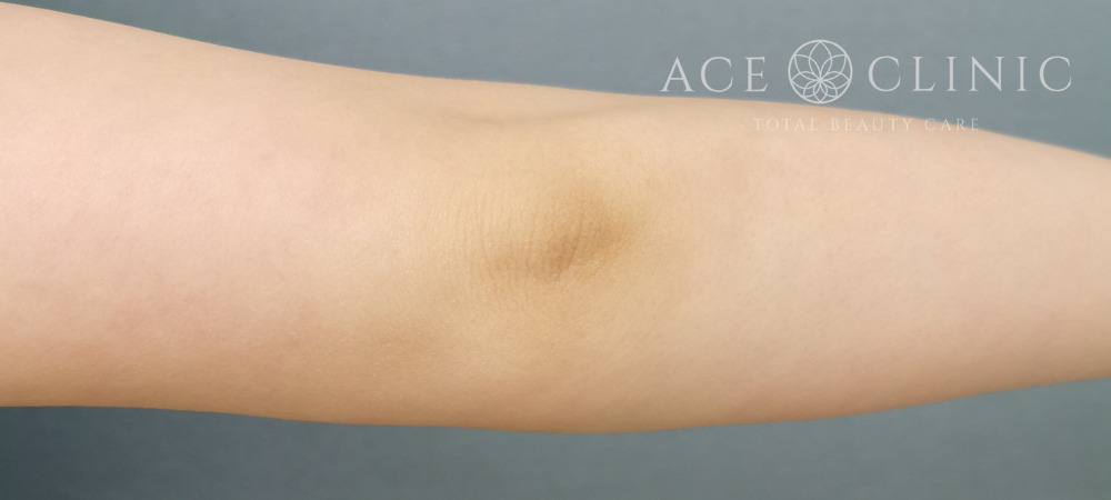 ミラノリピール｜20代女性｜症例｜術前｜エースクリニック大阪梅田HEPナビオ院