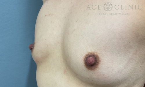 乳頭縮小｜症例56｜40代女性｜術後1ヶ月｜エースクリニック大阪梅田HEPナビオ院