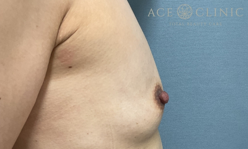 乳頭縮小｜症例56｜40代女性｜術後1ヶ月｜エースクリニック大阪梅田HEPナビオ院