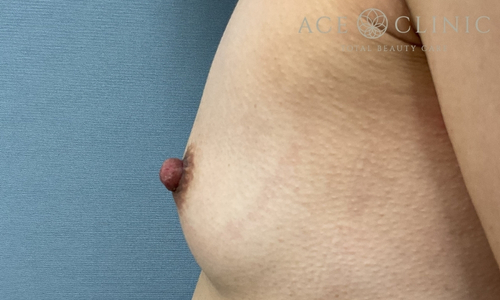 乳頭縮小｜症例56｜40代女性｜術後1ヶ月｜エースクリニック大阪梅田HEPナビオ院