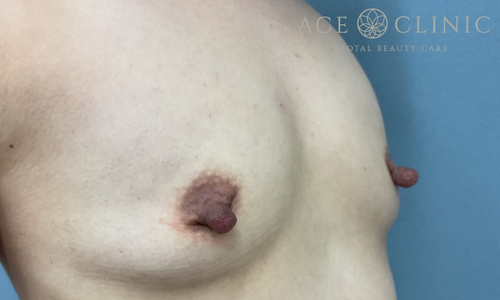 乳頭縮小｜症例56｜40代女性｜術前｜エースクリニック大阪梅田HEPナビオ院
