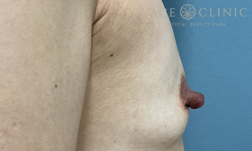 乳頭縮小｜症例56｜40代女性｜術前｜エースクリニック大阪梅田HEPナビオ院