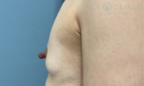 乳頭縮小｜症例56｜40代女性｜術前｜エースクリニック大阪梅田HEPナビオ院