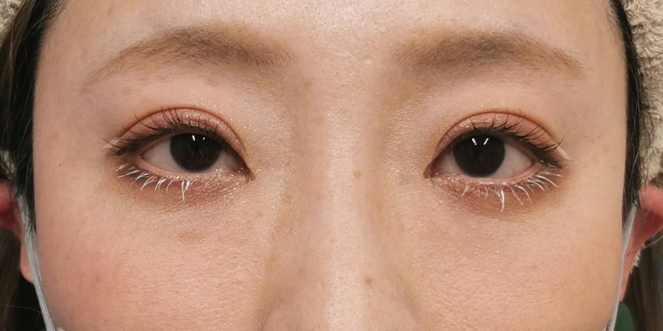 眼瞼下垂|症例103|50代女性|術後|エースクリニック大阪梅田HEPナビオ院