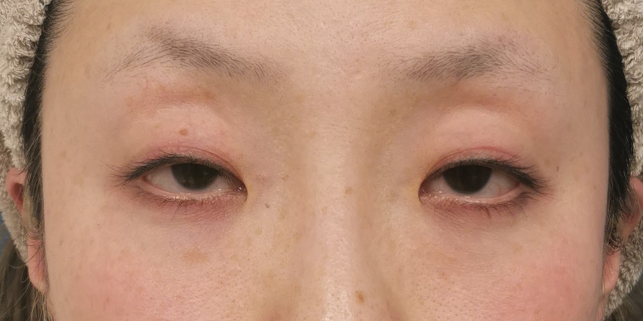 眼瞼下垂|症例103|50代女性|術前|エースクリニック大阪梅田HEPナビオ院