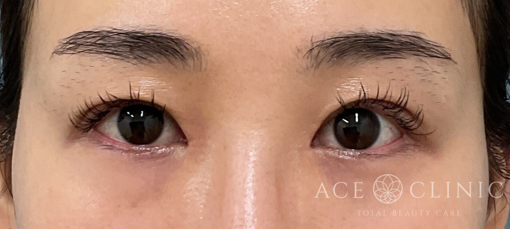 眼瞼下垂｜症例104｜30代女性｜術後1ヶ月｜エースクリニック大阪梅田HEPナビオ院