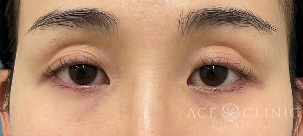 眼瞼下垂｜症例104｜30代女性｜術前｜エースクリニック大阪梅田HEPナビオ院