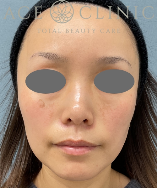 ルビーフラクショナル|症例5|30代女性|術後3回|エースクリニック大阪梅田HEPナビオ院