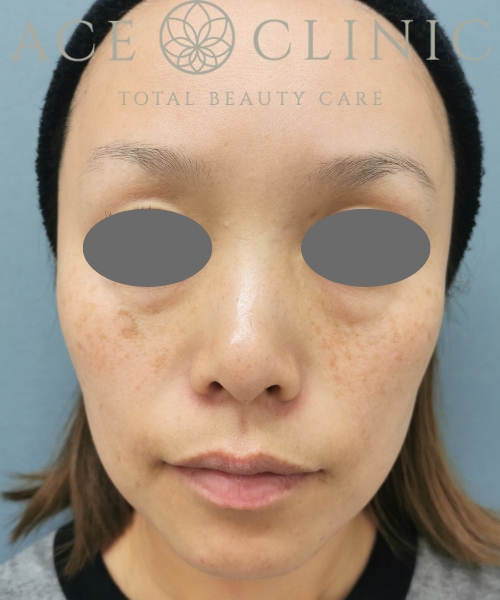 ルビーフラクショナル|症例5|30代女性|術前|エースクリニック大阪梅田HEPナビオ院