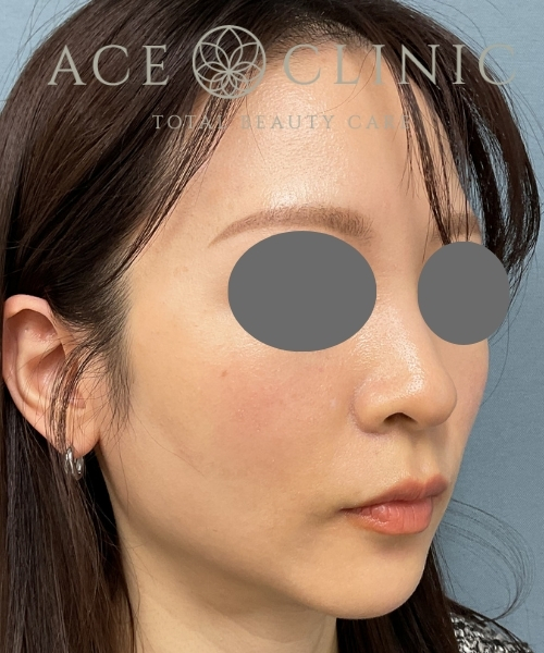 症例29｜30代女性｜術後1ヶ月｜エースクリニック大阪梅田HEPナビオ院