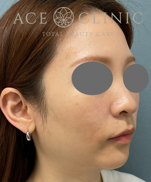 フェイスボトックス｜症例29｜30代女性｜術前｜エースクリニック大阪梅田HEPナビオ院