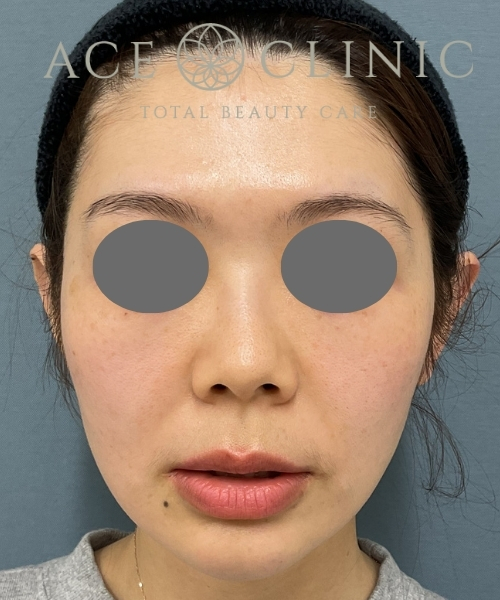 オリジオKISS｜症例1｜30代女性｜術後1ヶ月｜エースクリニック大阪梅田HEPナビオ院