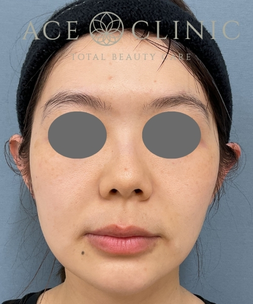 オリジオKISS｜症例1｜30代女性｜術前｜エースクリニック大阪梅田HEPナビオ院