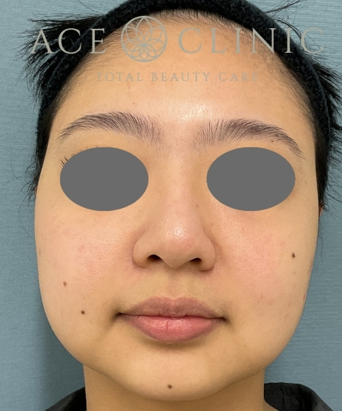 オンダリフト｜症例２｜30代女性｜術後３ヶ月｜エースクリニック大阪梅田HEPナビオ院