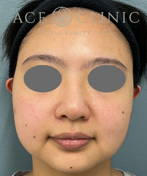 オンダリフト｜症例２｜30代女性｜術前｜エースクリニック大阪梅田HEPナビオ院