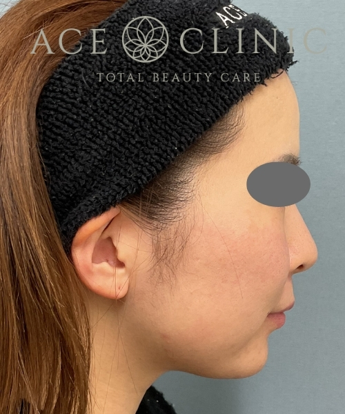 オンダリフト|症例3|30代女性|術後1ヶ月|エースクリニック大阪梅田HEPナビオ院