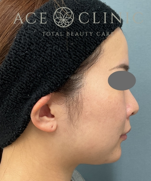 オンダリフト|症例3|30代女性|術前|エースクリニック大阪梅田HEPナビオ院