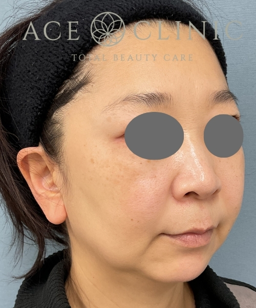 オンダリフト｜症例4｜50代女性｜術後1ヶ月｜エースクリニック大阪梅田HEPナビオ院