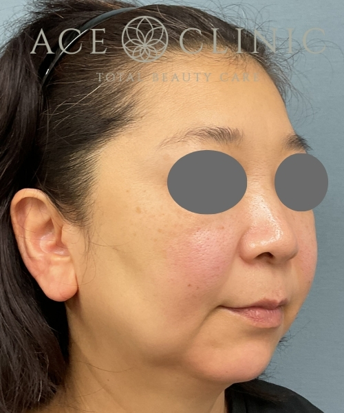 オンダリフト｜症例４｜50代女性｜術前｜エースクリニック大阪梅田HEPナビオ院