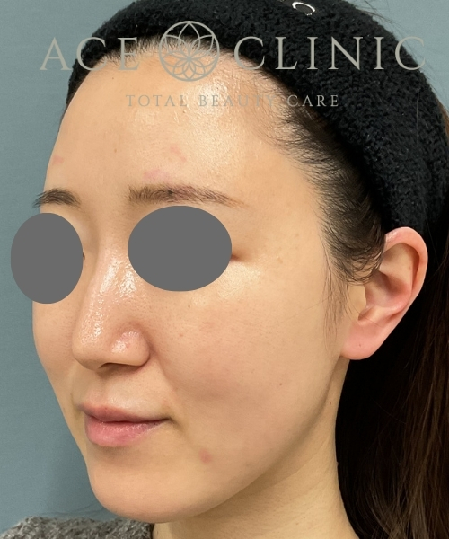 オンダリフト｜症例4｜30代女性｜術後4ヶ月｜エースクリニック大阪梅田HEPナビオ院