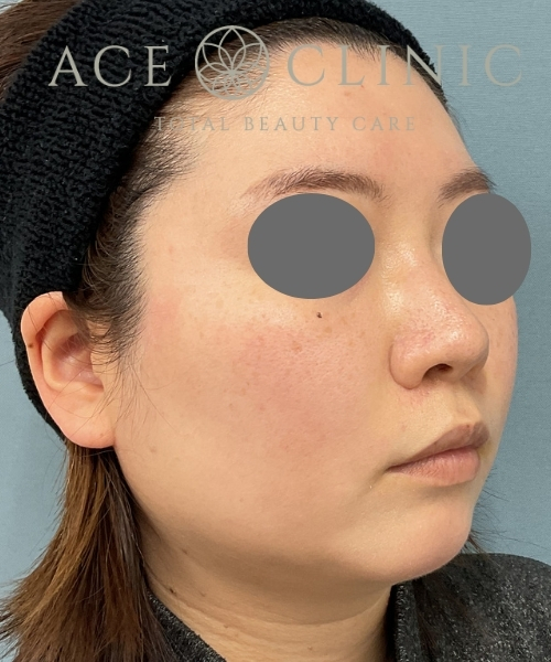 オンダリフト｜症例６｜20代女性｜術後1ヶ月｜エースクリニック大阪梅田HEPナビオ院