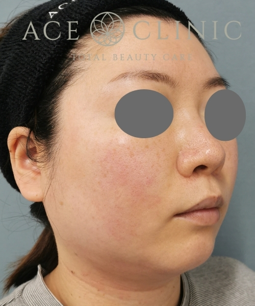 オンダリフト｜症例6｜20代女性｜術前｜エースクリニック大阪梅田HEPナビオ院