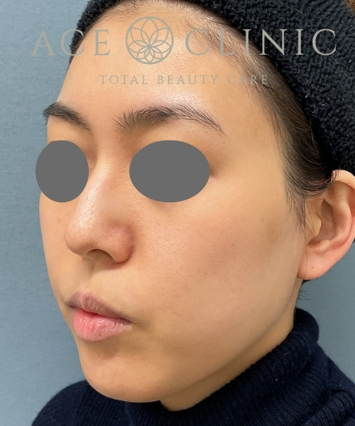 リポットレーザー｜症例５｜30代女性｜術後1ヶ月｜エースクリニック大阪梅田HEPナビオ院