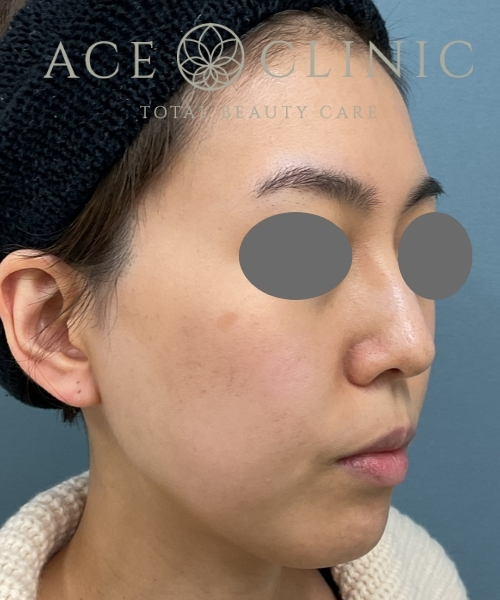 リポットレーザー｜症例５｜30代女性｜術前｜エースクリニック大阪梅田HEPナビオ院