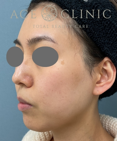 リポットレーザー｜症例５｜30代女性｜術前｜エースクリニック大阪梅田HEPナビオ院