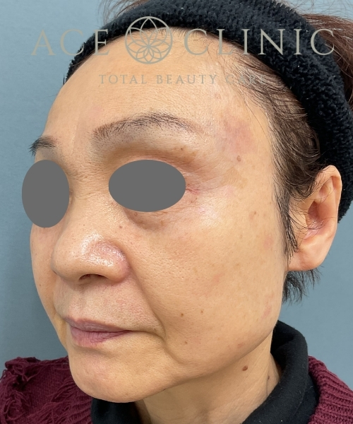 リポットレーザー｜症例6｜60代女性｜術後1ヶ月｜エースクリニック大阪梅田HEPナビオ院