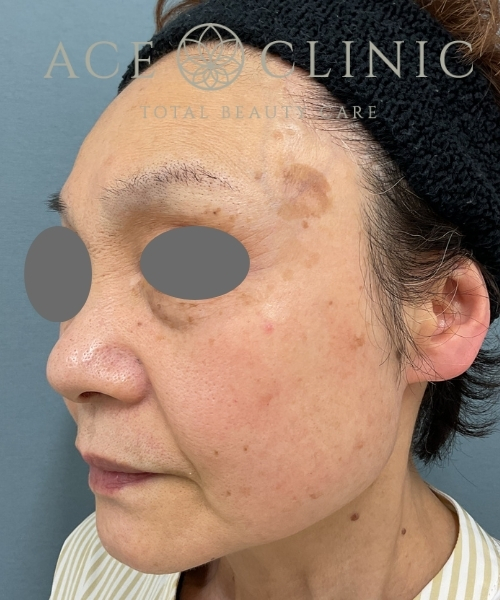 リポットレーザー｜症例6｜60代女性｜術前｜エースクリニック大阪梅田HEPナビオ院