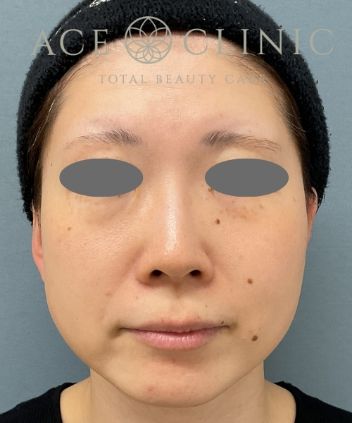 ルビーフラクショナル｜症例6｜30代女性｜術前｜エースクリニック大阪梅田HEPナビオ院