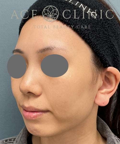 ルビーフラクショナル｜症例7｜20代女性｜術後1ヶ月｜エースクリニック大阪梅田HEPナビオ院