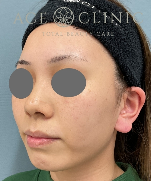 ルビーフラクショナル｜症例7｜20代女性｜術前｜エースクリニック大阪梅田HEPナビオ院