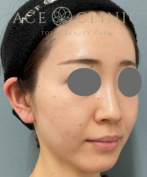 ジャルプロ｜症例1｜20代女性｜術後1ヶ月｜エースクリニック大阪梅田HEPナビオ院