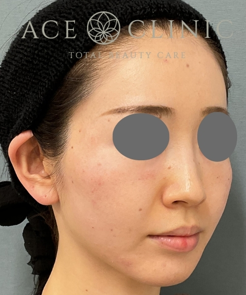 ジャルプロ｜症例1｜20代女性｜術前｜エースクリニック大阪梅田HEPナビオ院