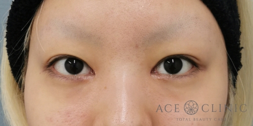 二重まぶた埋没法＋目頭切開｜症例9｜20代女性｜術後3ヶ月｜大阪梅田HEPナビオ院