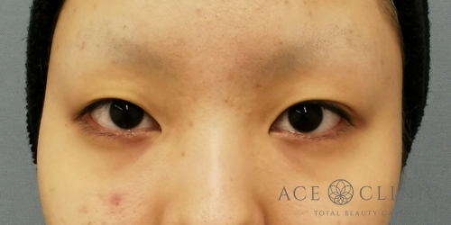 二重まぶた埋没法＋目頭切開｜症例9｜20代女性｜術前｜大阪梅田HEPナビオ院