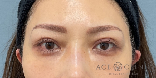 経結膜ハムラ法｜症例62｜40代女性｜術後1年｜エースクリニック大阪梅田HEPナビオ院