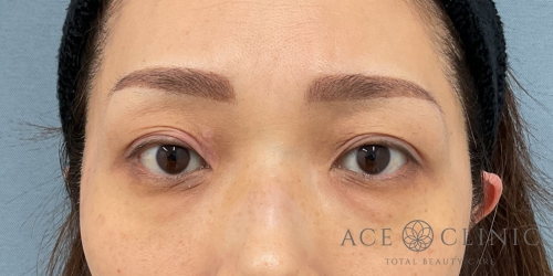 経結膜ハムラ法｜症例62｜40代女性｜術前｜エースクリニック大阪梅田HEPナビオ院